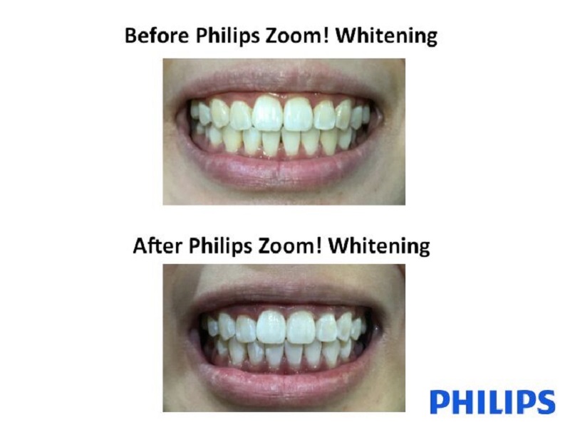 Philips-Zoom!