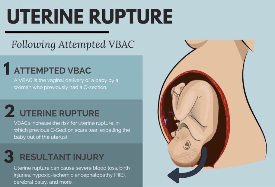 uterine ruptue for late pregnancy