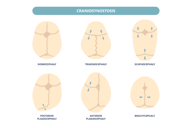 craniosynostosis